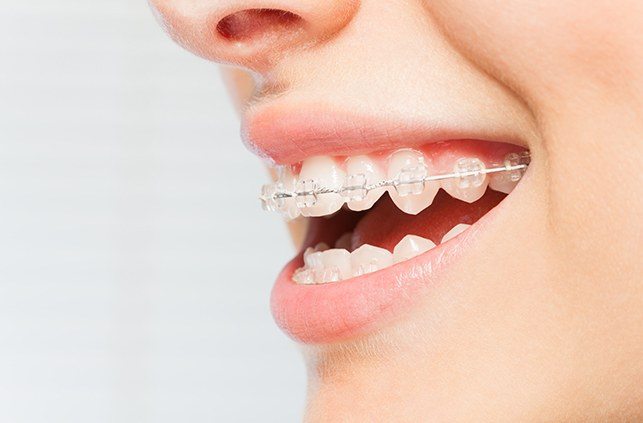 Clear Braces Lawrence, MA, Adult Orthodontics