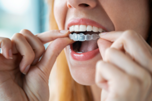 a patient inserting their Invisalign aligner